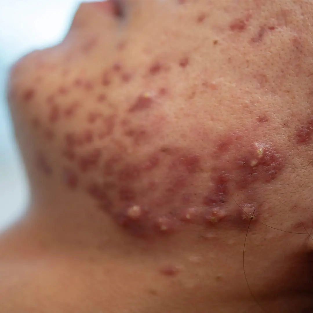 AKNE Care Hautpflege-Balsam